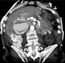 Hepatic Artery Aneurysm - CTisus CT Scan