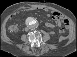 Endoleak - CTisus CT Scan