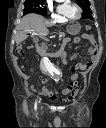 Endoleak - CTisus CT Scan