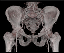 Iliac Artery ?? - CTisus CT Scan