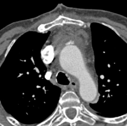 Leak Off Ascending Aorta With Bleeding - CTisus CT Scan