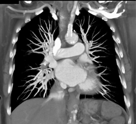 Stent in Subclavian Artery - CTisus CT Scan