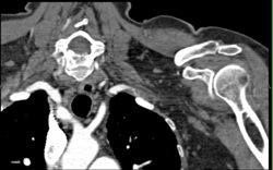 Clot in Subclavian Artery - CTisus CT Scan