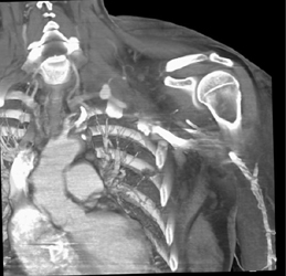 Pseudoaneurysm Off Subclavian Artery - CTisus CT Scan