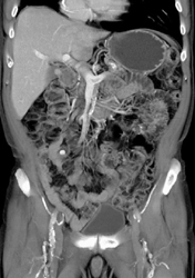 Clot in Confluence of Portal Vein (PV) and Splenic Vein - CTisus CT Scan