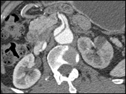 Dissection Extends Into the SMA - CTisus CT Scan