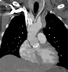 Aortic Valve Replacement - CTisus CT Scan