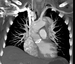 Aortic Valve Replacement - CTisus CT Scan