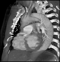 Type B Dissection - CTisus CT Scan