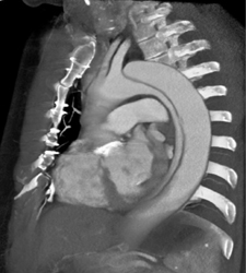 Type B Dissection - CTisus CT Scan