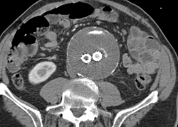 Occluded Limb of Stent - CTisus CT Scan