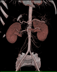 Error on Auto-bone Removal-sacrum and Manual Correction-see Subsequent Images - CTisus CT Scan