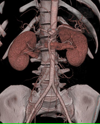 Normal CTA - CTisus CT Scan