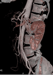 Normal CTA - CTisus CT Scan