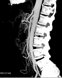 Normal CTA - CTisus CT Scan