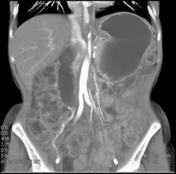 Normal CTA - CTisus CT Scan