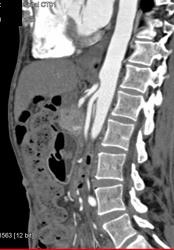 Normal CTA - CTisus CT Scan