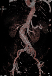 Aortic Disease - CTisus CT Scan