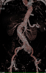 Normal CTA - CTisus CT Scan