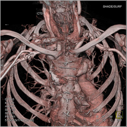 SMA Aneurysm in Loeys-Dietz - CTisus CT Scan