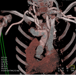 Subclavian Artery Aneurysm - CTisus CT Scan