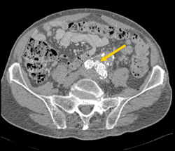 Endoleak - CTisus CT Scan