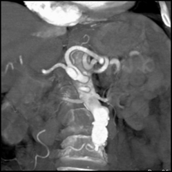 Focal Dissection Off Hepatic Artery - CTisus CT Scan