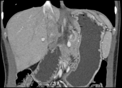 Superior Mesenteric Artery (SMA) Syndrome With Dilated Duodenum - CTisus CT Scan