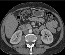 Normal SMA to Renal Vein Relationship - CTisus CT Scan