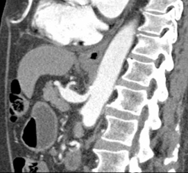 Narrowed Celiac With Post Stenotic Dilation?? - CTisus CT Scan
