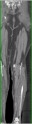 Run Off Study With Segmentation Tools - CTisus CT Scan