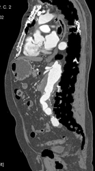 Abdominal Aortic Aneurysm (AAA) With Iliac Aneurysms - CTisus CT Scan