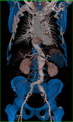 Abdominal Aortic Aneurysm (AAA) With Attempt at Automated Segmentation - CTisus CT Scan