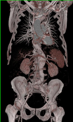 AAA-VRT vs MIP - CTisus CT Scan