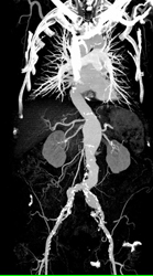 Bone Editing Saves the Day With MIP - CTisus CT Scan