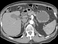 Dilated Celiac Artery With Median Arcuate Ligament Syndrome - CTisus CT Scan