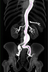 Center Line Measurements - CTisus CT Scan