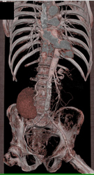 Area Measurement for Stents - CTisus CT Scan