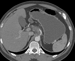 Bleed From Celiac Artery Aneurysm - CTisus CT Scan