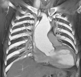 Dilated Ascending Aorta - CTisus CT Scan