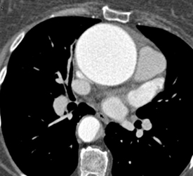 Dilated Ascending Aorta - CTisus CT Scan