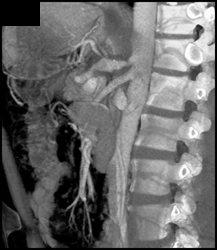Dilated Celiac Artery - CTisus CT Scan