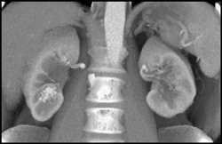 Arteriovenous (AV) Fistulae in Right Kidney - CTisus CT Scan