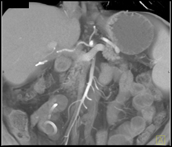 Normal SMA Branching - CTisus CT Scan