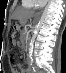 Clot in Celiac Artery - CTisus CT Scan