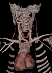 Ectatic Carotid Artery in Loeys-Dietz Syndrome - CTisus CT Scan