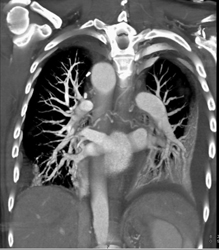 Right Arch With Chd - CTisus CT Scan