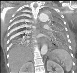 Intramural Hematoma With Bleed Due to Ulcer Through Aortic Wall - CTisus CT Scan
