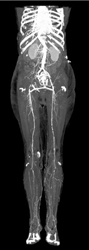 Occluded Right External Iliac Artery With Fem-fem Bypass - CTisus CT Scan