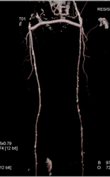 Multiple Stenosis in SFA - CTisus CT Scan